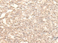 Immunohistochemistry of paraffin-embedded Human lung cancer tissue using RAD23B Polyclonal Antibody at dilution of 1:25 (×200)