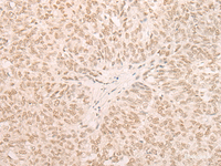 Immunohistochemistry of paraffin-embedded Human ovarian cancer tissue using EIF4A3 Polyclonal Antibody at dilution of 1:35 (×200)