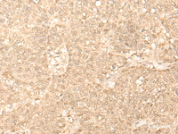 Immunohistochemistry of paraffin-embedded Human ovarian cancer tissue using FAH Polyclonal Antibody at dilution of 1:40 (×200)