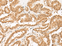 Immunohistochemistry of paraffin-embedded Human thyroid cancer tissue using ZBTB8A Polyclonal Antibody at dilution of 1:70 (×200)