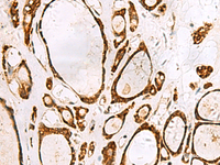 Immunohistochemistry of paraffin-embedded Human thyroid cancer tissue using GRWD1 Polyclonal Antibody at dilution of 1:55 (×200)
