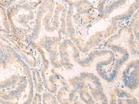 Immunohistochemistry of paraffin-embedded Human thyroid cancer tissue using SEPT10 Polyclonal Antibody at dilution of 1:25 (×200)