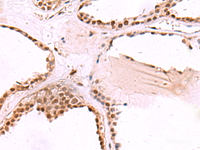 Immunohistochemistry of paraffin-embedded Human thyroid cancer tissue using RUVBL1 Polyclonal Antibody at dilution of 1:65 (×200)