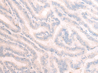 Immunohistochemistry of paraffin-embedded Human thyroid cancer tissue using TBC1D2 Polyclonal Antibody at dilution of 1:25 (×200)