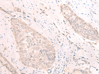 Immunohistochemistry of paraffin-embedded Human esophagus cancer tissue using TBC1D2 Polyclonal Antibody at dilution of 1:25 (×200)