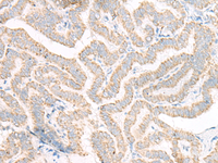 Immunohistochemistry of paraffin-embedded Human thyroid cancer tissue using ACSF2 Polyclonal Antibody at dilution of 1:30 (×200)