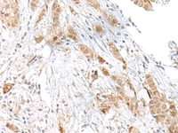 Immunohistochemistry of paraffin-embedded Human breast cancer tissue using TCF25 Polyclonal Antibody at dilution of 1:40 (×200)