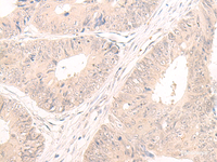 Immunohistochemistry of paraffin-embedded Human colorectal cancer tissue using LCMT2 Polyclonal Antibody at dilution of 1:55 (×200)