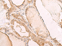 Immunohistochemistry of paraffin-embedded Human thyroid cancer tissue using PBXIP1 Polyclonal Antibody at dilution of 1:40 (×200)