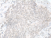 Immunohistochemistry of paraffin-embedded Human esophagus cancer tissue using ORC1 Polyclonal Antibody at dilution of 1:65 (×200)