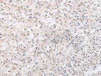 Immunohistochemistry of paraffin-embedded Human liver cancer tissue using ORC1 Polyclonal Antibody at dilution of 1:65 (×200)