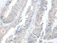 Immunohistochemistry of paraffin-embedded Human colorectal cancer tissue using GBA2 Polyclonal Antibody at dilution of 1:55 (×200)