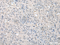 Immunohistochemistry of paraffin-embedded Human cervical cancer tissue using EPM2A Polyclonal Antibody at dilution of 1:75 (×200)