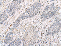 Immunohistochemistry of paraffin-embedded Human esophagus cancer tissue using EPM2A Polyclonal Antibody at dilution of 1:75 (×200)