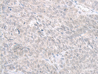 Immunohistochemistry of paraffin-embedded Human ovarian cancer tissue using STAU2 Polyclonal Antibody at dilution of 1:60 (×200)