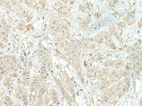 Immunohistochemistry of paraffin-embedded Human breast cancer tissue using MIEN1 Polyclonal Antibody at dilution of 1:100 (×200)