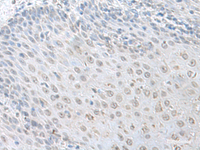 Immunohistochemistry of paraffin-embedded Human esophagus cancer tissue using LSM10 Polyclonal Antibody at dilution of 1:100 (×200)