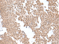 Immunohistochemistry of paraffin-embedded Human ovarian cancer tissue using SNRNP25 Polyclonal Antibody at dilution of 1:55 (×200)