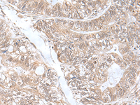 Immunohistochemistry of paraffin-embedded Human gastric cancer tissue using SNRNP25 Polyclonal Antibody at dilution of 1:55 (×200)