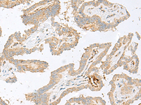 Immunohistochemistry of paraffin-embedded Human thyroid cancer tissue using HBG1:HBG2 Polyclonal Antibody at dilution of 1:100 (×200)