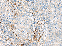 Immunohistochemistry of paraffin-embedded Human cervical cancer tissue using HBG1:HBG2 Polyclonal Antibody at dilution of 1:100 (×200)