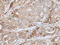 Immunohistochemistry of paraffin-embedded Human liver cancer tissue using MRM1 Polyclonal Antibody at dilution of 1:85 (×200)