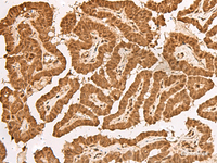 Immunohistochemistry of paraffin-embedded Human thyroid cancer tissue using TIPRL Polyclonal Antibody at dilution of 1:65 (×200)