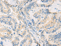 Immunohistochemistry of paraffin-embedded Human thyroid cancer tissue using SYNGR1 Polyclonal Antibody at dilution of 1:50 (×200)