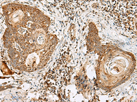 Immunohistochemistry of paraffin-embedded Human esophagus cancer tissue using CD48 Polyclonal Antibody at dilution of 1:40 (×200)
