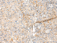 Immunohistochemistry of paraffin-embedded Human cervical cancer tissue using MDFI Polyclonal Antibody at dilution of 1:50 (×200)