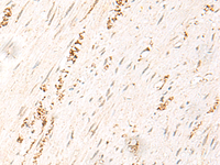 Immunohistochemistry of paraffin-embedded Human colorectal cancer tissue using MDFI Polyclonal Antibody at dilution of 1:50 (×200)