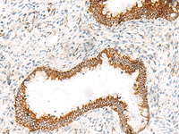 Immunohistochemistry of paraffin-embedded Human cervical cancer tissue using ORC4 Polyclonal Antibody at dilution of 1:70 (×200)