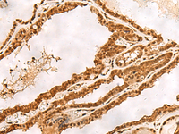 Immunohistochemistry of paraffin-embedded Human thyroid cancer tissue using PSMA3 Polyclonal Antibody at dilution of 1:30 (×200)