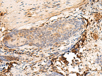 Immunohistochemistry of paraffin-embedded Human esophagus cancer tissue using HLA-DQB1 Polyclonal Antibody at dilution of 1:30 (×200)