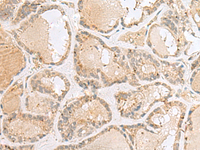 Immunohistochemistry of paraffin-embedded Human thyroid cancer tissue using CNPY3 Polyclonal Antibody at dilution of 1:55 (×200)