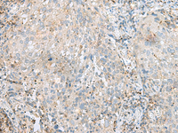 Immunohistochemistry of paraffin-embedded Human cervical cancer tissue using SEPT1 Polyclonal Antibody at dilution of 1:60 (×200)