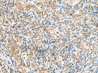 Immunohistochemistry of paraffin-embedded Human cervical cancer tissue using SNAPC1 Polyclonal Antibody at dilution of 1:60 (×200)