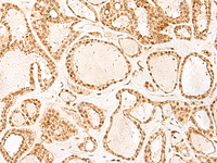 Immunohistochemistry of paraffin-embedded Human thyroid cancer tissue using PSPC1 Polyclonal Antibody at dilution of 1:25 (×200)