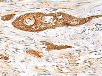 Immunohistochemistry of paraffin-embedded Human esophagus cancer tissue using GPSM1 Polyclonal Antibody at dilution of 1:85 (×200)