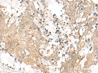 Immunohistochemistry of paraffin-embedded Human lung cancer tissue using GPSM1 Polyclonal Antibody at dilution of 1:85 (×200)