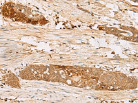 Immunohistochemistry of paraffin-embedded Human esophagus cancer tissue using PSMD12 Polyclonal Antibody at dilution of 1:50 (×200)