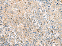 Immunohistochemistry of paraffin-embedded Human cervical cancer tissue using EIF3L Polyclonal Antibody at dilution of 1:55 (×200)