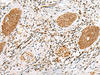 Immunohistochemistry of paraffin-embedded Human esophagus cancer tissue using NUP58 Polyclonal Antibody at dilution of 1:60 (×200)