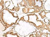 Immunohistochemistry of paraffin-embedded Human thyroid cancer tissue using PDIA4 Polyclonal Antibody at dilution of 1:50 (×200)