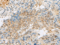 Immunohistochemistry of paraffin-embedded Human cervical cancer tissue using PRPF3 Polyclonal Antibody at dilution of 1:30 (×200)