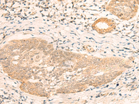 Immunohistochemistry of paraffin-embedded Human esophagus cancer tissue using CALCOCO1 Polyclonal Antibody at dilution of 1:40 (×200)