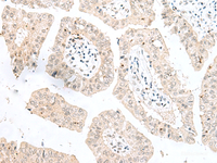 Immunohistochemistry of paraffin-embedded Human liver cancer tissue using NGEF Polyclonal Antibody at dilution of 1:35 (×200)