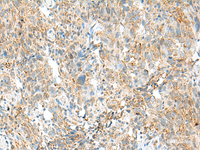 Immunohistochemistry of paraffin-embedded Human cervical cancer tissue using MCCC1 Polyclonal Antibody at dilution of 1:45 (×200)