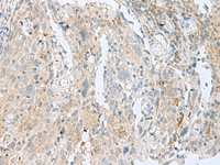 Immunohistochemistry of paraffin-embedded Human cervical cancer tissue using SLC26A3 Polyclonal Antibody at dilution of 1:35 (×200)