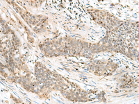 Immunohistochemistry of paraffin-embedded Human esophagus cancer tissue using LIG4 Polyclonal Antibody at dilution of 1:60 (×200)